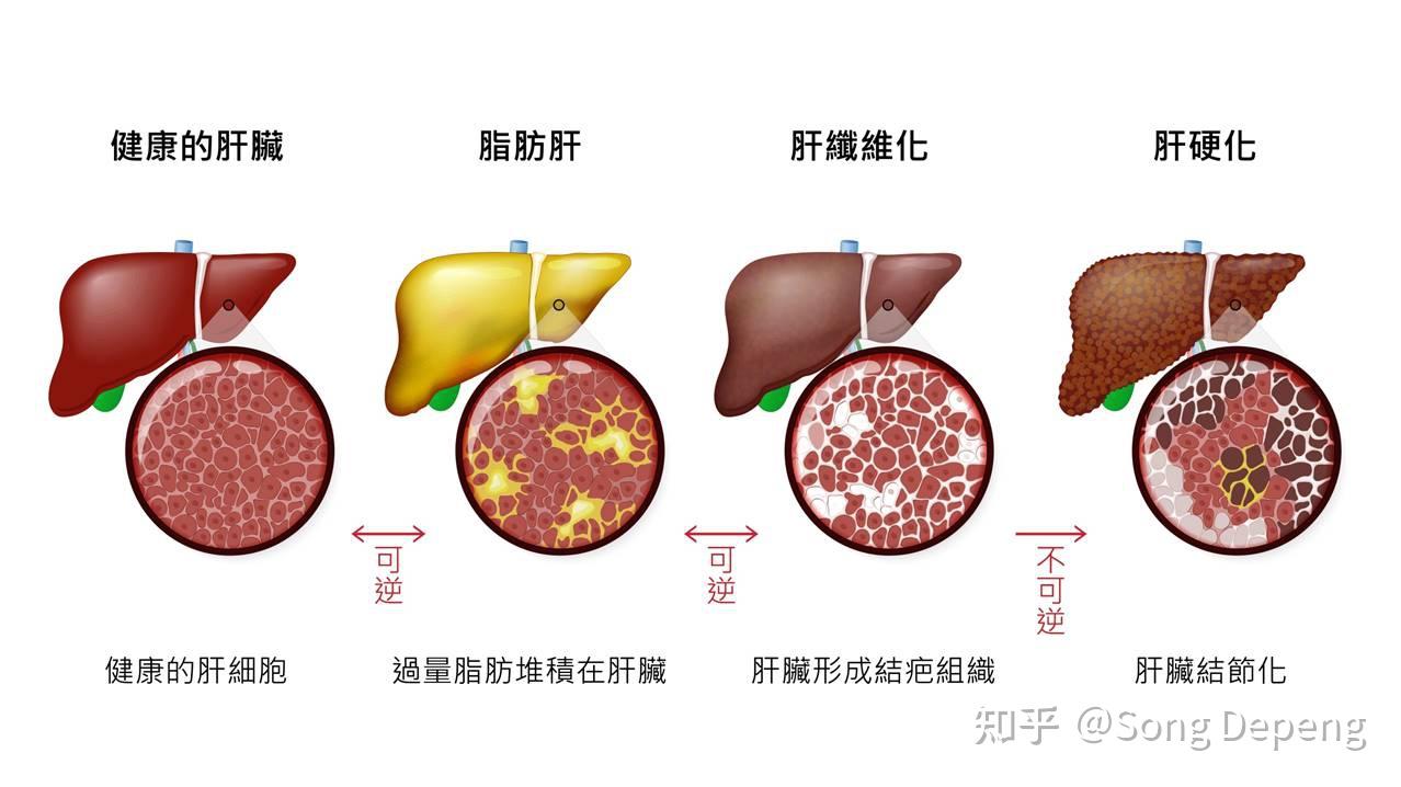 肝纤维化，一种疾病，其严重性如何？